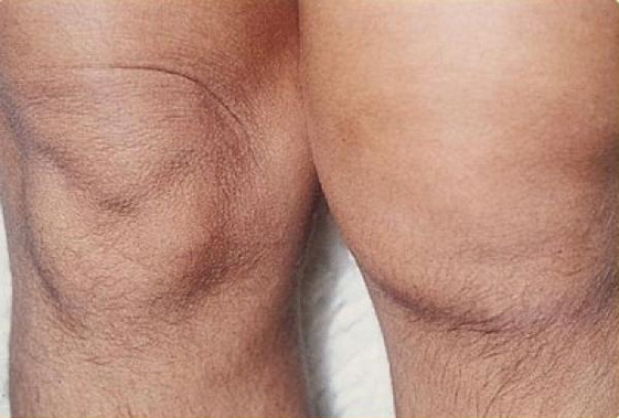 Two knees with one affected with arthritis.